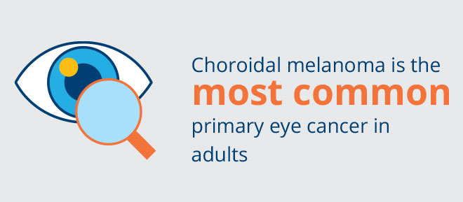 Choroidal melanoma is the most common primary eye cancer in adults